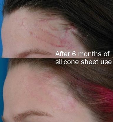 Silicone sheets before after scars